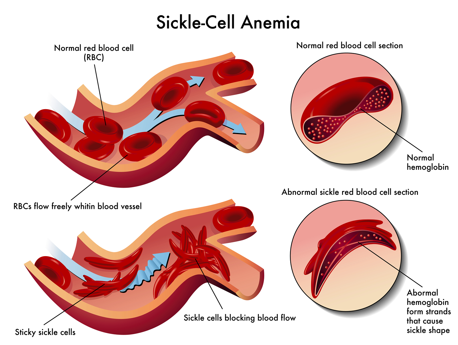 All you need to know about Sickle Cell Disease