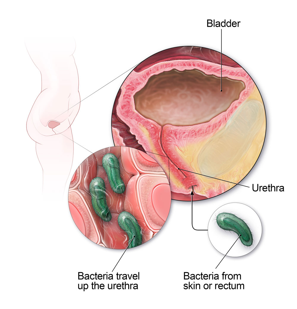 Urinary tract infections happen when bacteria, often from the skin or rectum, travel up the urethra and into the bladder