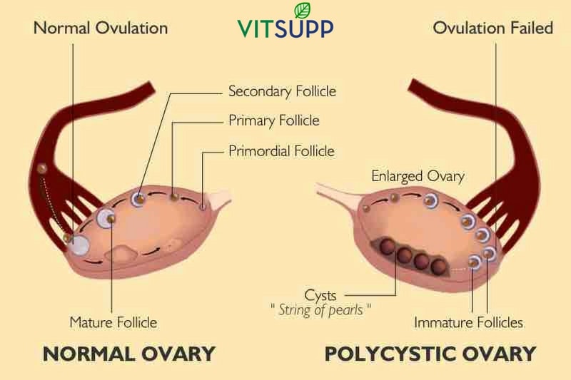 What is PCOD problem in females.