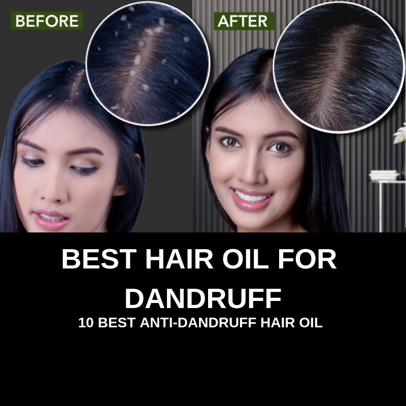 BEST HAIR OIL FOR DANDRUFF (BEST ANTI DANDRUFF HAIR OIL)