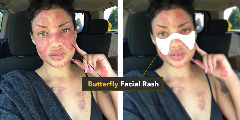 lupus butterfly facial rash