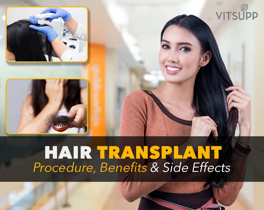 is hair transplant permanent cure