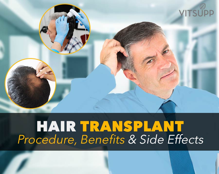 What is Hair Transplant, How is it Done and More