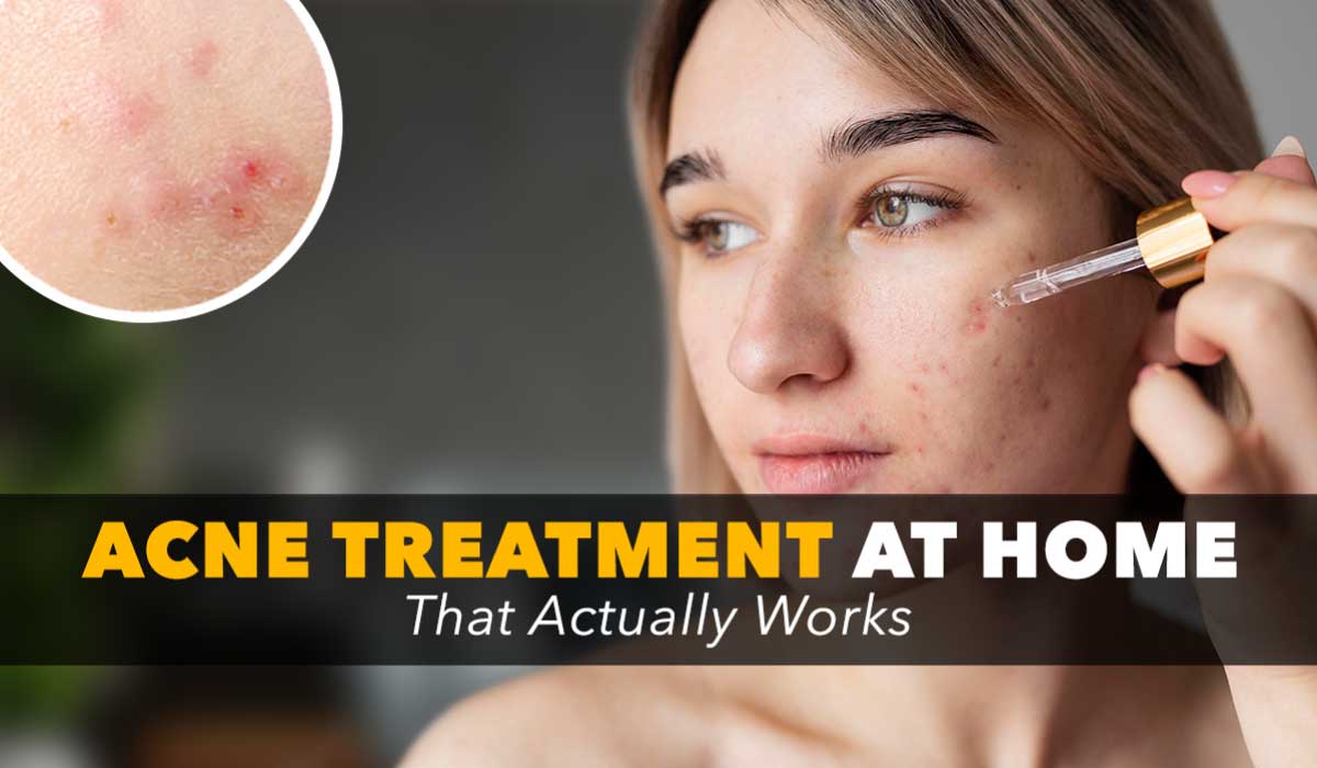 ACNE TREATMENT AT HOME THAT ACTUALLY WORKS