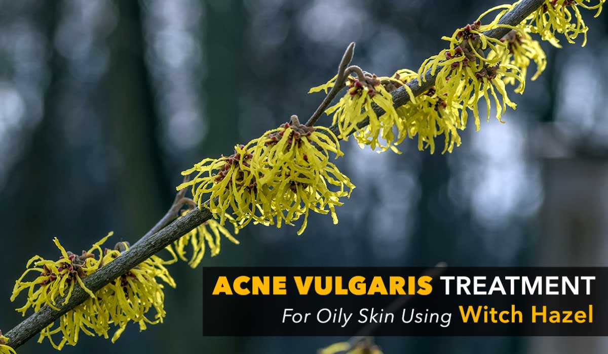 acne treatment at home for oily skin